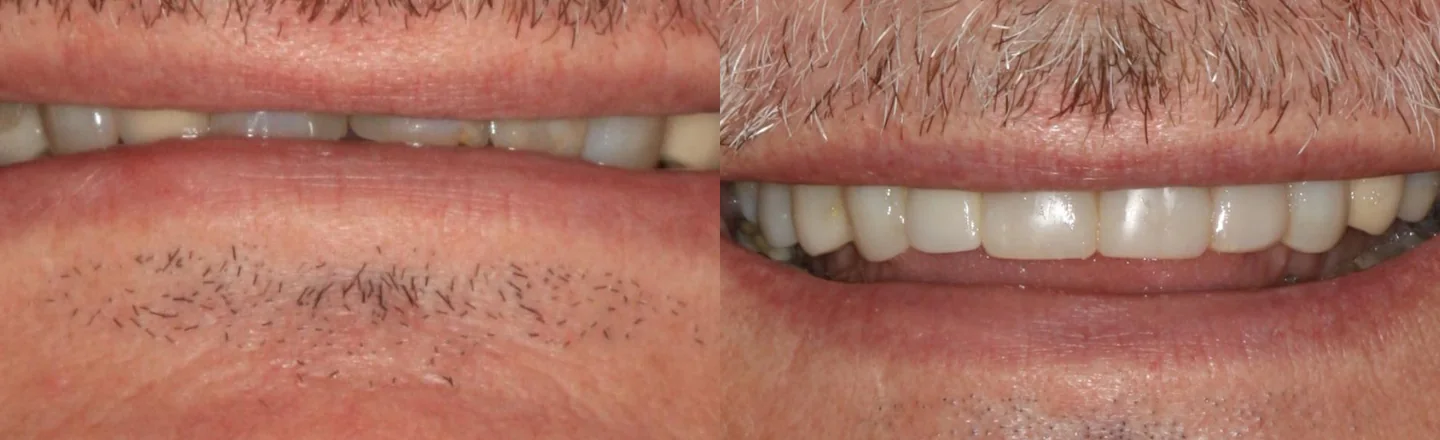 Comparação do sorriso antes e depois da cirurgia e reabilitação bucal, recortada à região oral.
