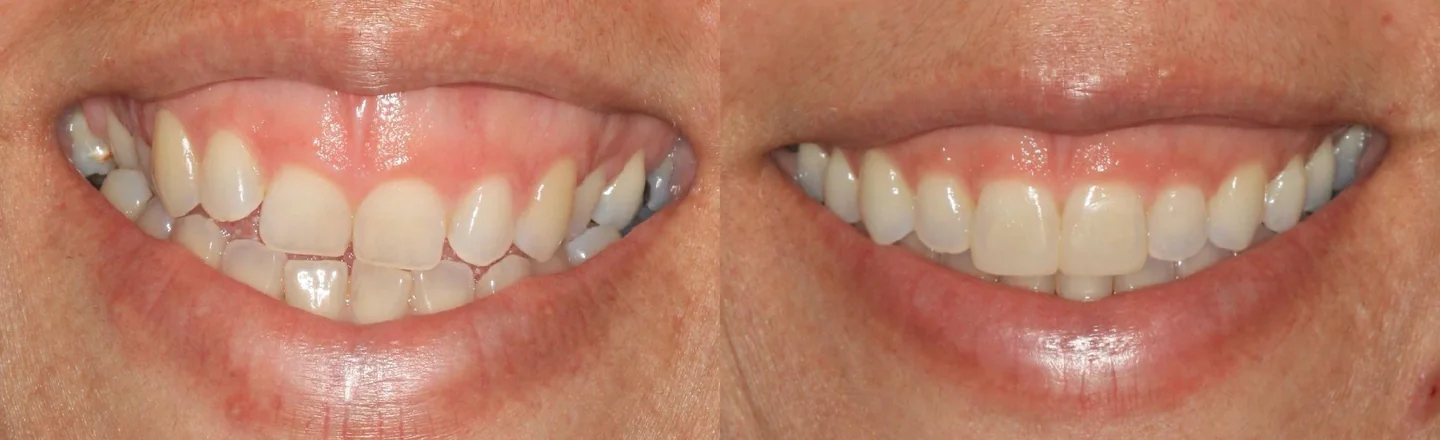 Comparação do sorriso antes e depois de ortodontia estética, recortada à região oral.