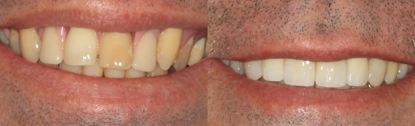 Comparação do sorriso antes e depois do tratamento de ortodontia e reabilitação, recortada à região oral.