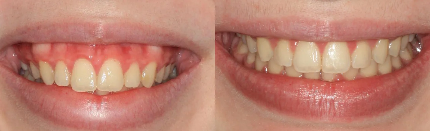 Comparação do sorriso antes e depois de cirurgia ortognática, recortada à região oral.