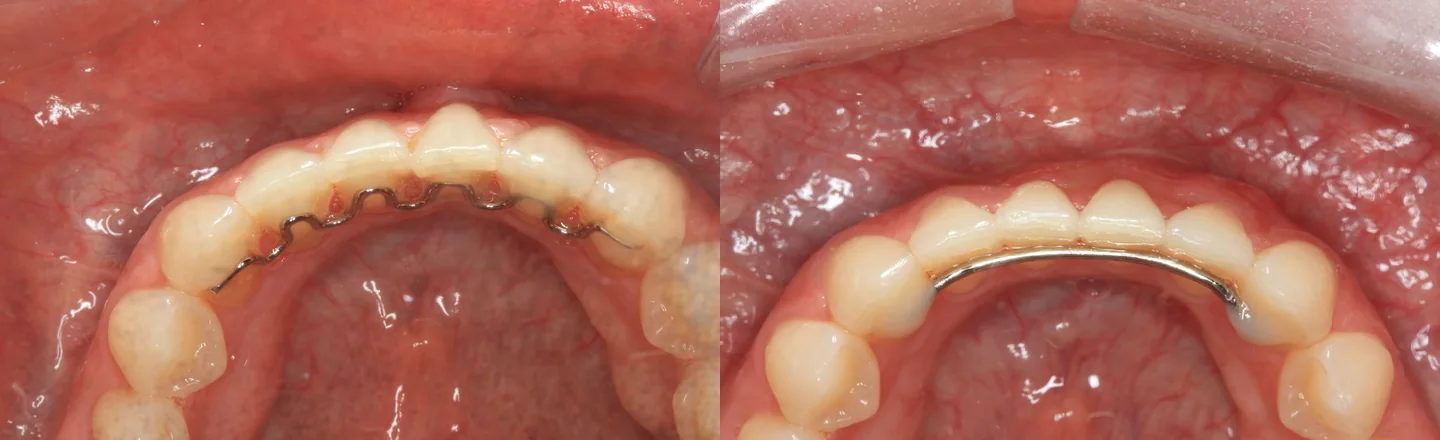 Comparação antes e depois de registros intraorais de periodontia estética.