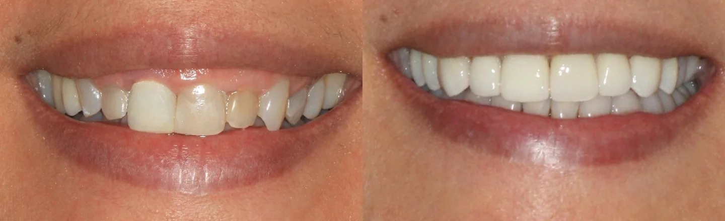 Comparação do sorriso antes e depois de tratamento integrado com implante, recortada à região oral.