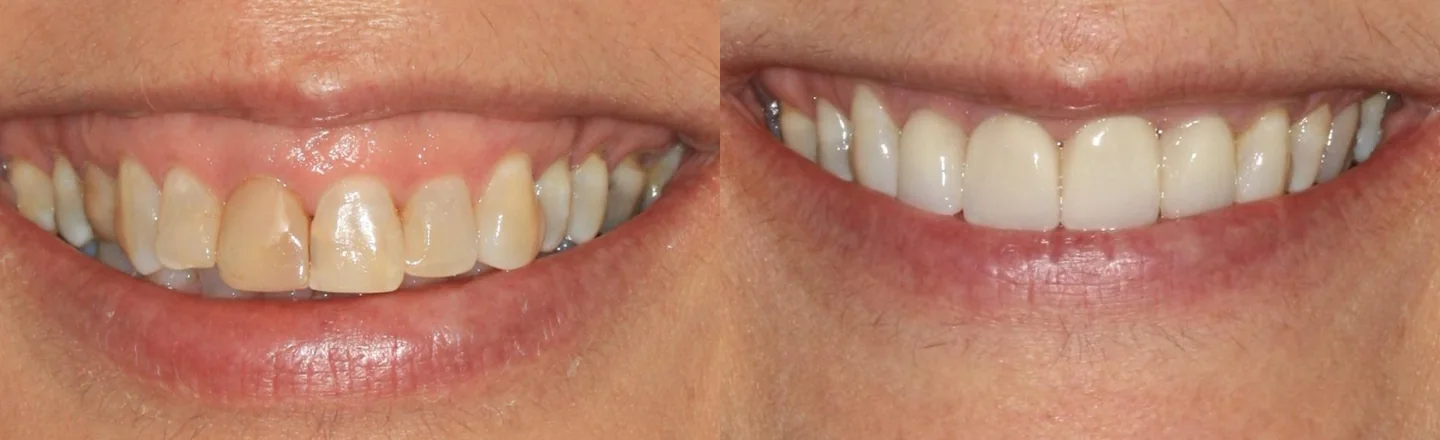 Comparação do sorriso antes e depois do tratamento periodontal e reabilitador, recortada à região oral.